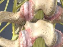 Facet Joint Syndrome