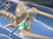 Hip Joint Injection