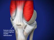 Lateral Release and Medial Imbrication