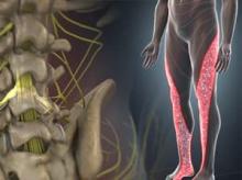 Lumbar Radiculopathy (Sciatica)