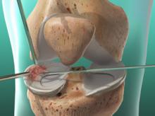 Meniscus Repair