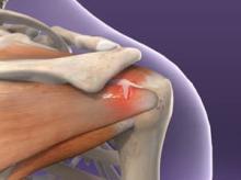 Rotator Cuff Injuries