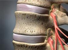 Spinal Stenosis